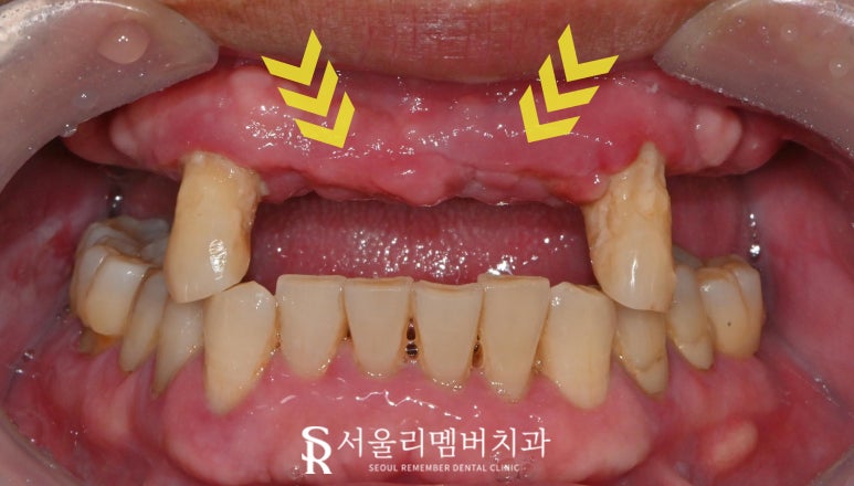 치아가 없을 땐? 서울대입구역 치과 에서 부기 통증 없는 최소절개 전체 디지털 임플란트 치료 관련 이미지 2