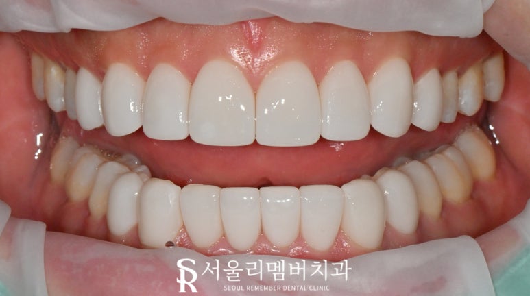 A Surge in Instagram DM Reservation Inquiries at Seoul National Univ. Entrance Station Dental Clinic: A Complete Rundown of Questions About Real Laminate image 9
