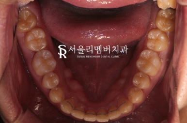 상도동치과 에서 발치 없이 깊게 물리는 과개교합 및 2급 부정교합 개선! 관련 이미지 10