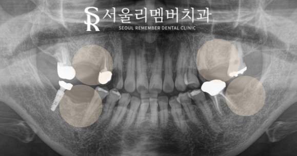 서울대입구역치과 "음식을 편하게 먹고 싶어요."  어금니 임플란트 임상 증례 관련 이미지 1