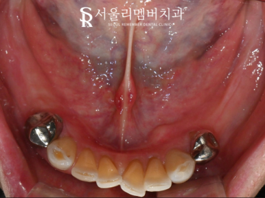 올바른 교합의 중요성, 서울대입구역치과 전체 임플란트 기간 및 과정 관련 이미지 3