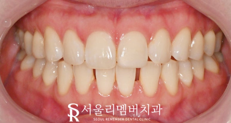 하악 전치 벌어진 공간 스페이스 해소를 위한 아래 앞니 6전치 리얼네이트 라미네이트 케이스 관련 이미지 2