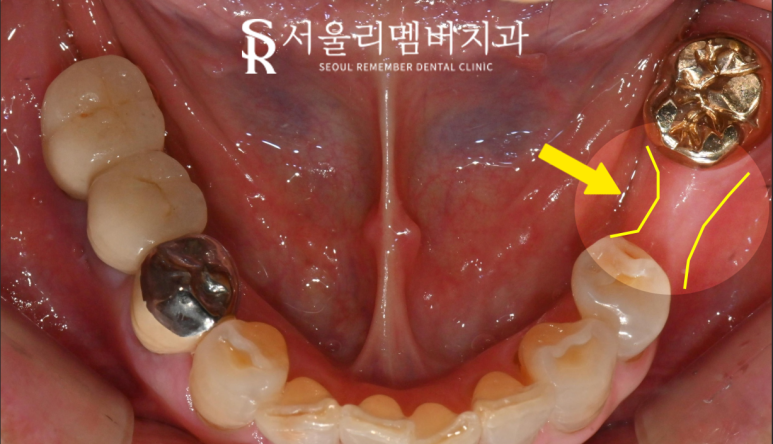 신림역 치과 오스템 BA 임플란트 당일 수술로 빠져버린 어금니 회복 관련 이미지 1