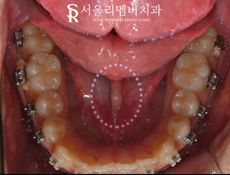 혀가 짧다? 설소대 절제술로 해결할 수 있습니다. 봉천동 치과 관련 이미지 5