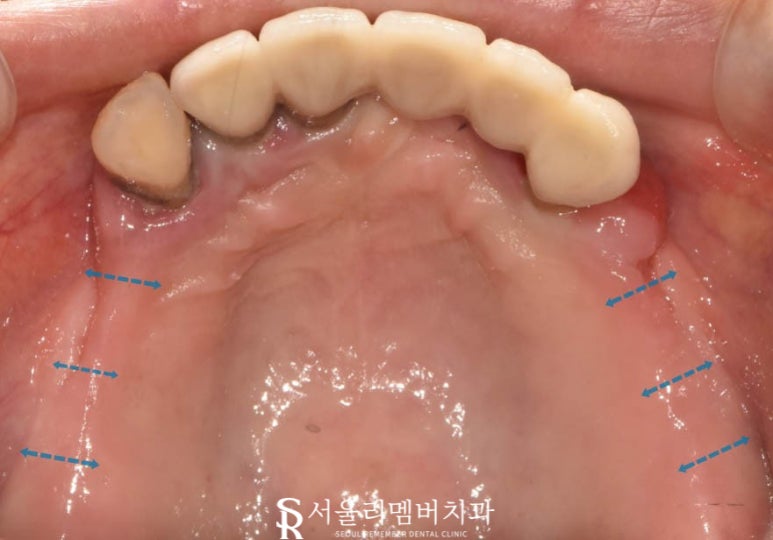 텅텅 여기저기 빠져버린 치아들, 이젠 음식을 씹을 수도 없어요.. 어떡하죠? 서울대입구역 리멤버 치과 관련 이미지 2