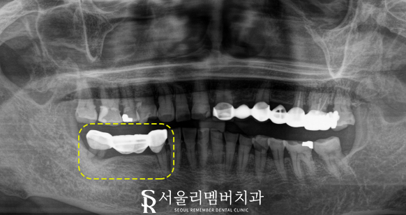 오래된 브릿지에 문제가 생겼어요. 서울대입구역 치과 에서 수면 임플란트 로 해결 관련 이미지 1
