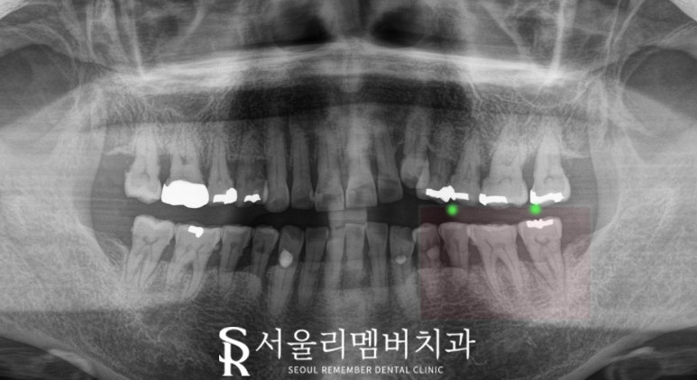 신림 치과 만 65세 이상 보험 임플란트 가격, 비용, 기간, 뼈이식, 크라운 종류 관련 이미지 2