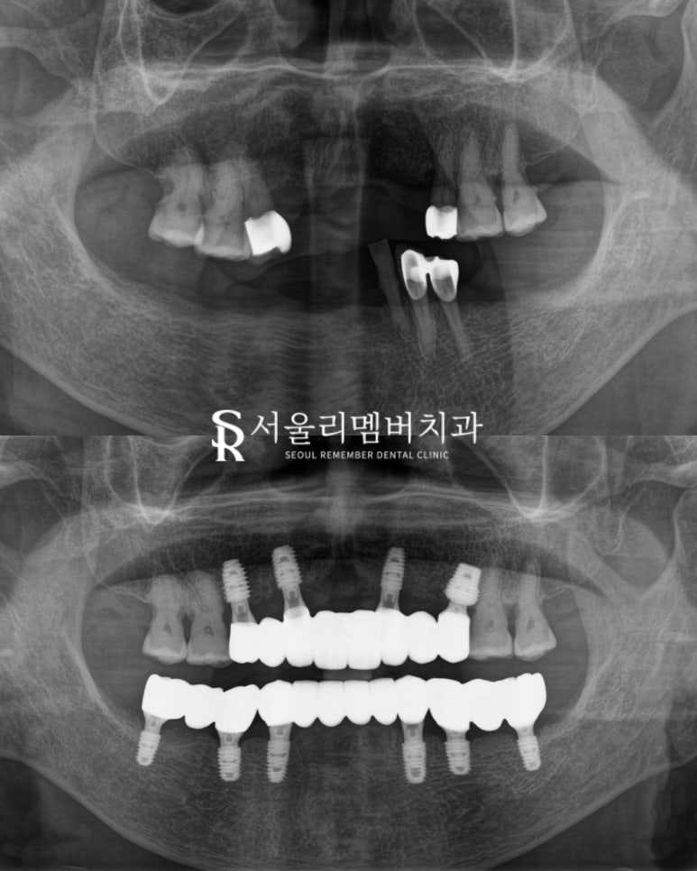 신림역 치과 "틀니는 쓰기 싫어요." 전체 임플란트 식립 후기 관련 이미지 8
