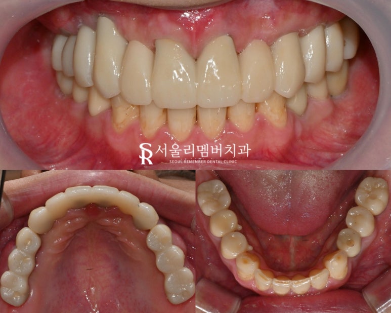 믿고 맡길 수 있는 신대방 치과 전체 임플란트 관련 이미지 4