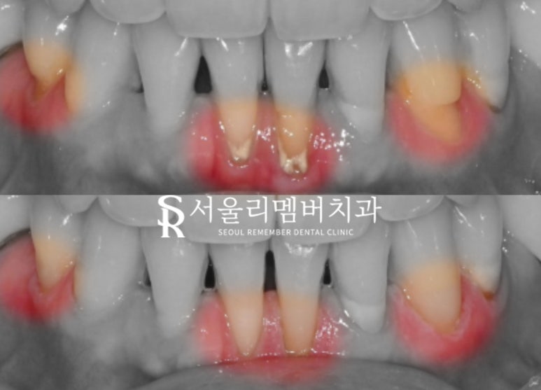"이가 누렇고 패어있어요." 신림 치과 에서 치경부 마모증 레진 치료와 치아 미백으로 개선한 증례 관련 이미지 2