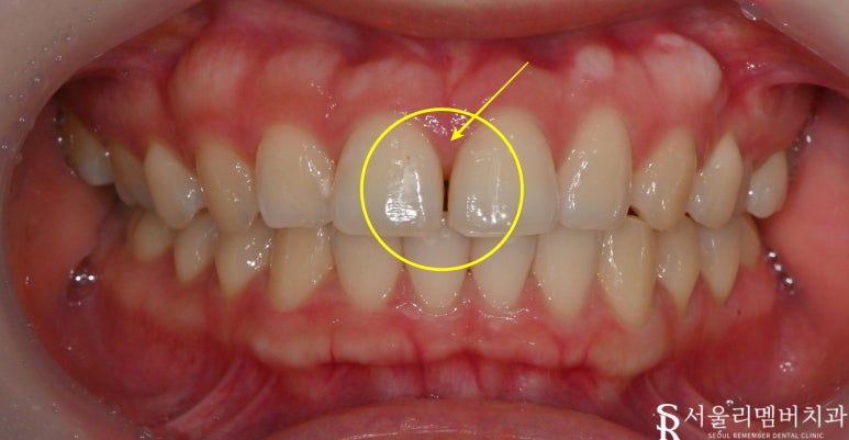 A “Pop-Out” Tooth, Cavities in the Front Teeth and Molars: Orthodontic and Cavity Treatment at a Sindae-bang Dental Clinic image 1