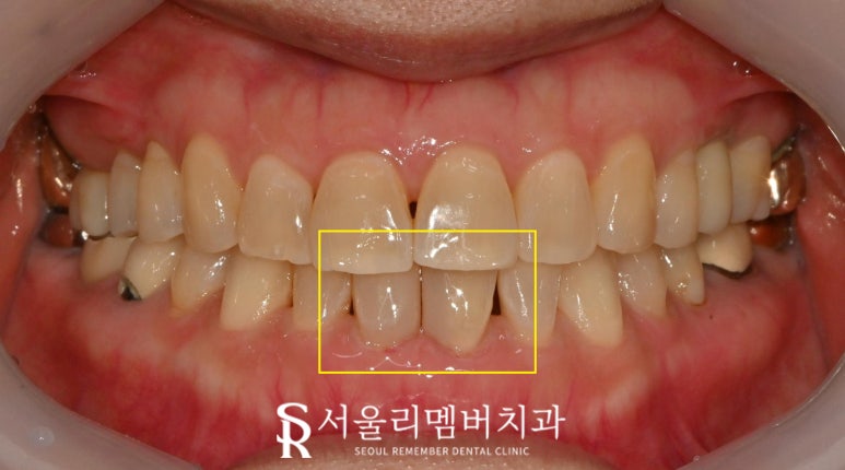 윗니 말고 아랫니! 사당 치과 아래 앞니 하악 전치 벌어진 공간 레진 다이아스태마(Diastema) 관련 이미지 6