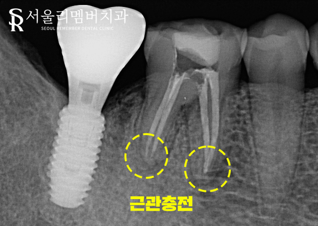 낙성대역 치과 신경치료가 필요한 경우는?! 관련 이미지 6