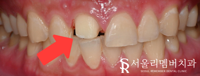 사당동 치과 에서 외상으로 인한 앞니 파절, 심미보철로 개선해 드렸습니다. 관련 이미지 2