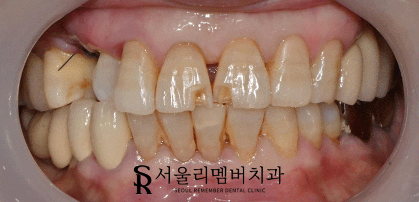 깨진 앞니를 어떤 방법으로 개선하는 게 좋을까? 서울대입구역 리멤버 치과 관련 이미지 1
