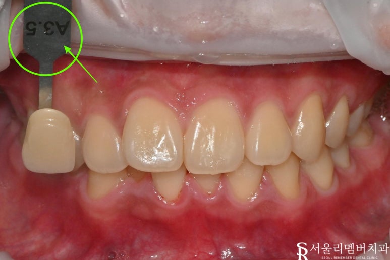 My Teeth Have Turned Yellow: The Transformation Process Through Aesthetic Professional Whitening at a Nakseongdae Station Dental Clinic image 1