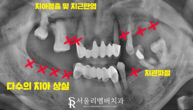 오래된 보철을 방치하면 결국 임플란트 식립밖에 남지 않게 됩니다! 봉천역 리멤버 치과 관련 이미지 2