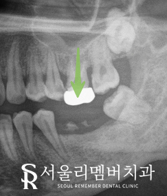 "구강에 빈 곳이 있으면 다른 치아가 우왕좌왕" 서울대입구역 치과 임플란트 수술 후기 관련 이미지 2