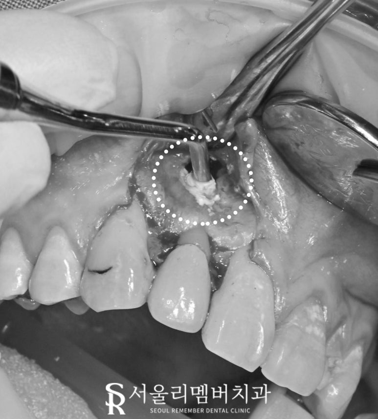 앞니 뿌리 끝 염증, 치근단 절제술(apicoectomy) 보라매 치과 관련 이미지 4