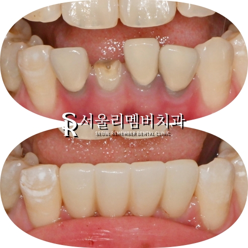 아래 앞니 부러짐 뿌리 끝 염증 봉천동 치과 하악 4전치 발치 후 오스템 임플란트 관련 이미지 8