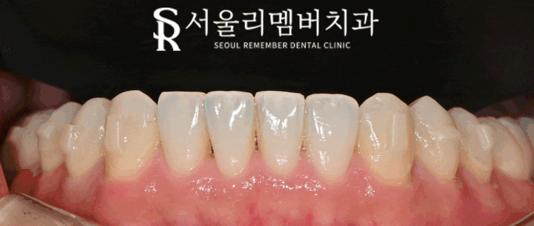 A Surge in Instagram DM Reservation Inquiries at Seoul National Univ. Entrance Station Dental Clinic: A Complete Rundown of Questions About Real Laminate image 4