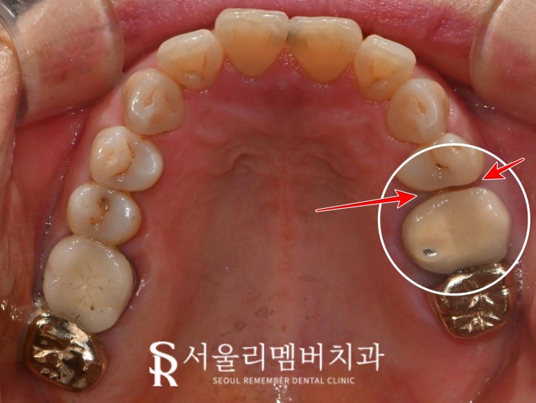 봉천역 치과 어금니 보철 후 음식물 끼임 및 치아 파절, 신경치료 크라운 및 임플란트 관련 이미지 2