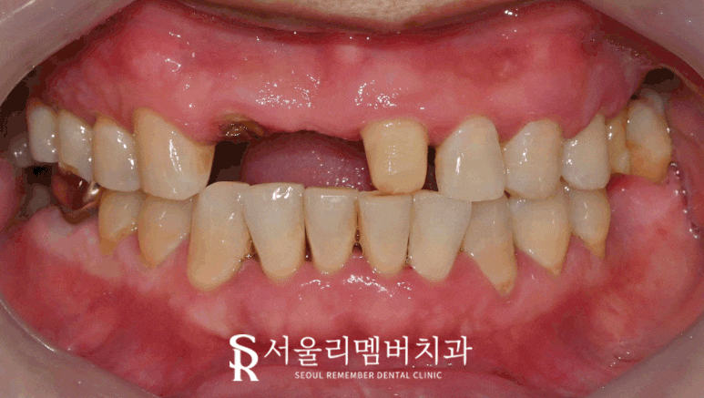 서울대입구 치과 환한 웃음을 되찾는 여정: 앞니 브릿지 탈락부터 임플란트를 통한 새로운 미소까지 관련 이미지 5