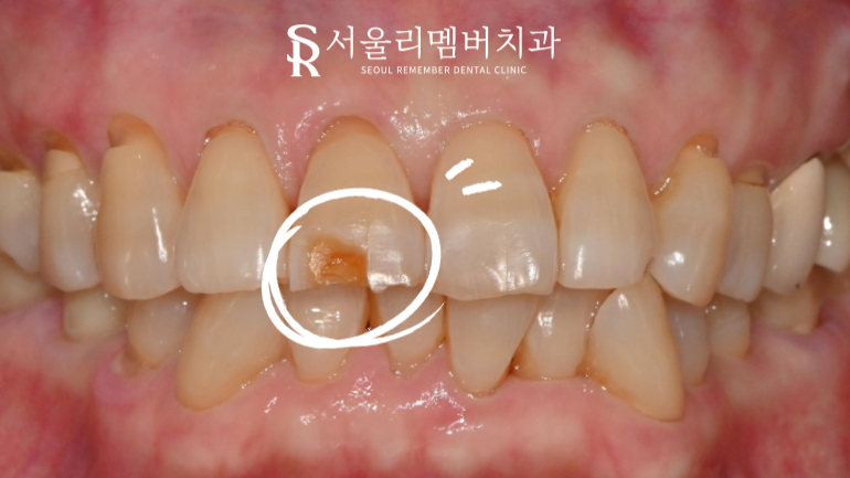 봉천역 치과 깨진 앞니와 치경부 마모, 레진 당일 수복 증례 관련 이미지 1