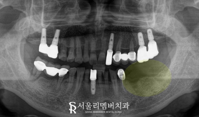 왼쪽 아래 어금니 임플란트 브릿지 장점, 진행 과정, 빨리 치료해야 되는 이유 상도동 치과 관련 이미지 3