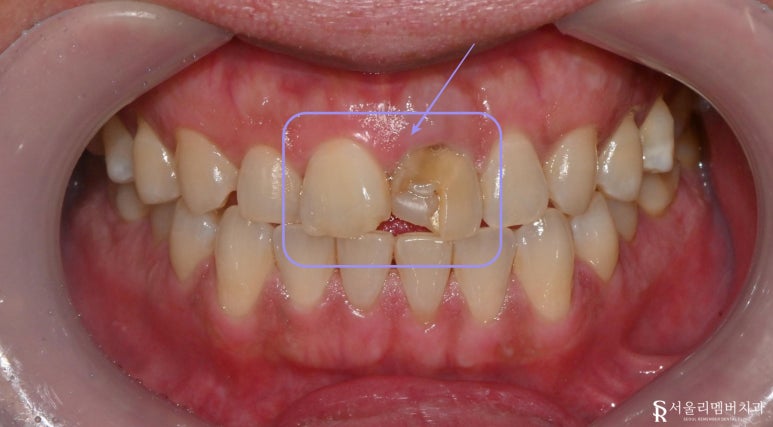 A Front Tooth Broken While Exercising: Crown Restoration After Root Canal Treatment at Boramae Dental Clinic image 1