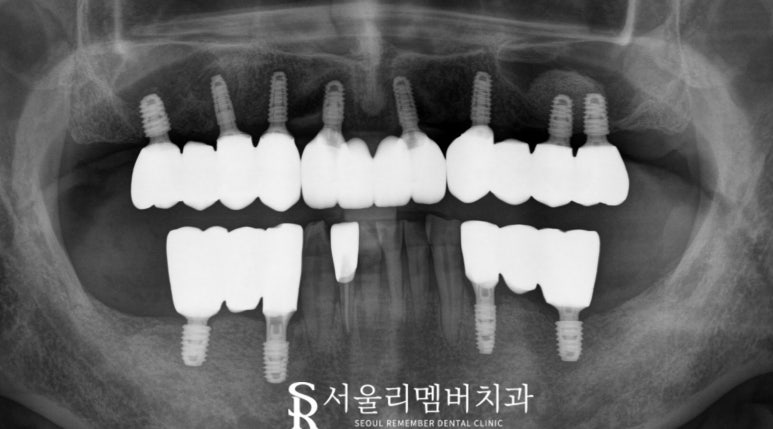 사당 치과, 틀니 대신 전체 임플란트로 새로운 구강 환경 되찾아 드린 사례 관련 이미지 6