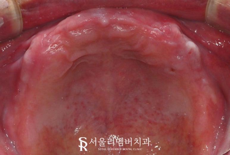 서울대입구역 치과 대표원장이 직접 봐드리는 무치악 환자 전체 임플란트 치료 케이스 관련 이미지 2