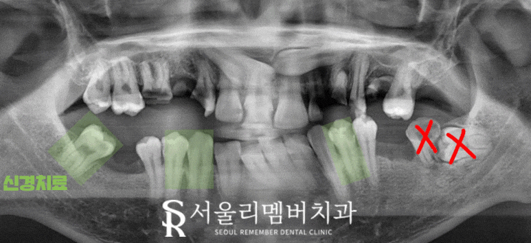 임플란트와 치아교정, 동시에 치료받을 수 있을까요? 남성역 서울 리멤버 치과 관련 이미지 4