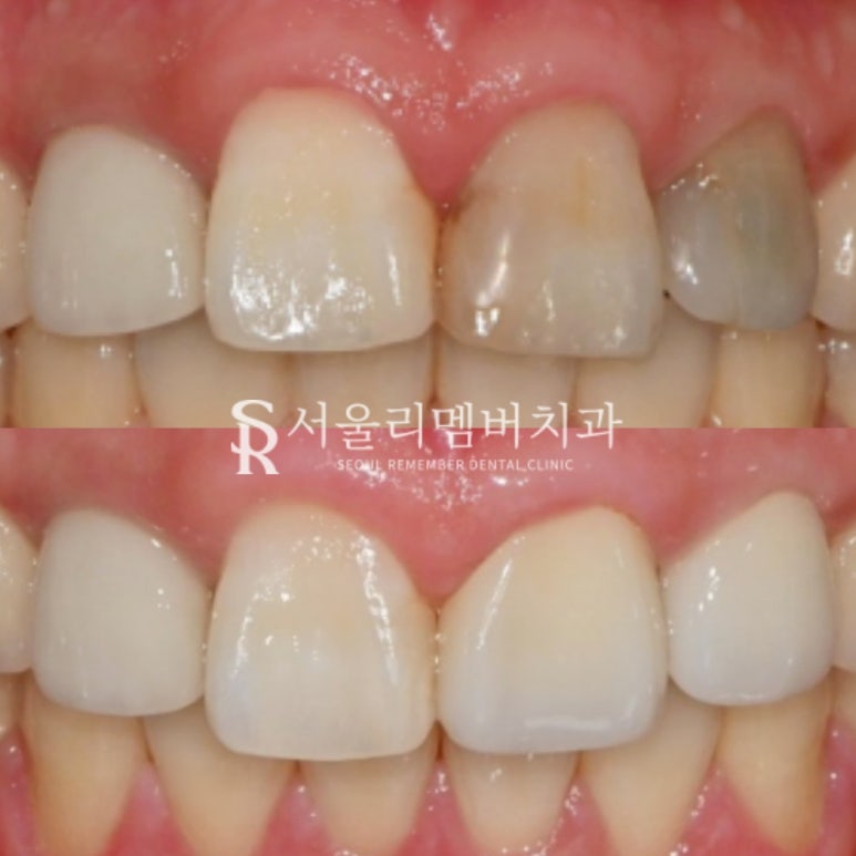 앞니 변색 이유는? 사당 치과 충치치료 로 환한 미소 되찾는 방법 관련 이미지 3