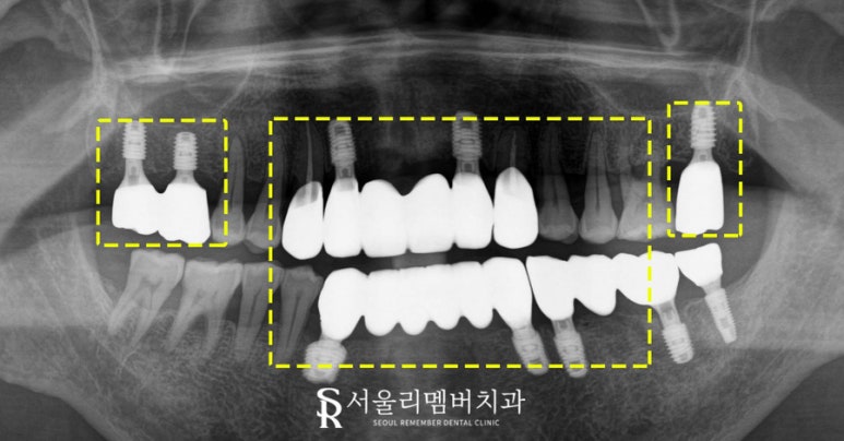 서울대입구역 치과 잇몸이 내려앉아서 고민이라면 전악 임플란트로 해결 관련 이미지 6