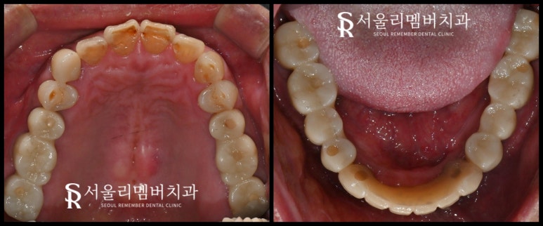 무너진 구강 환경 서울대입구역 치과 에서 편하게 전체 임플란트 치료한 사례 관련 이미지 6