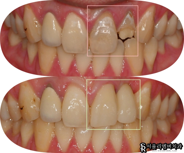 신대방 치과 앞니 충치와 약해진 치아 신경치료 크라운 및 부러진 측절치 발치 임플란트 관련 이미지 3
