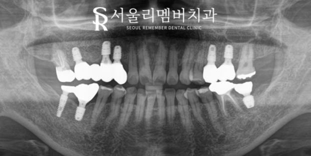 서울대입구역치과 "음식을 편하게 먹고 싶어요."  어금니 임플란트 임상 증례 관련 이미지 2