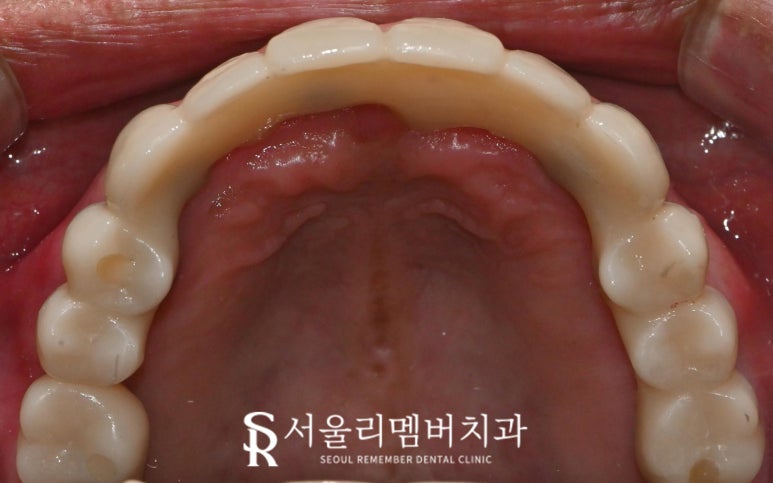 서울대입구역 치과 에서 안전하고 신속 정확하게 발치 후 전악 임플란트 식립한 케이스 관련 이미지 6
