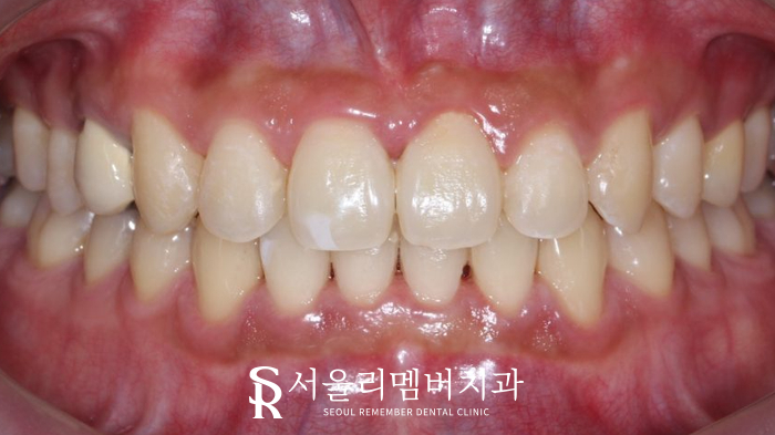 벌어진 치아, 사당 치과 인비절라인으로 개선할 수 있을까? 관련 이미지 8