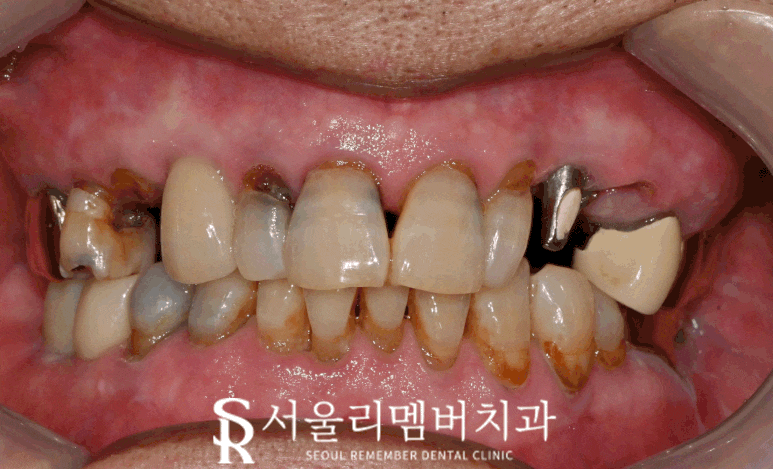 사당역 치과 충치, 치아 흔들림, 파절, 결손, 염증.. 다수의 복합 문제 생겼다면 임플란트 신경치료 크라운 과정 관련 이미지 5