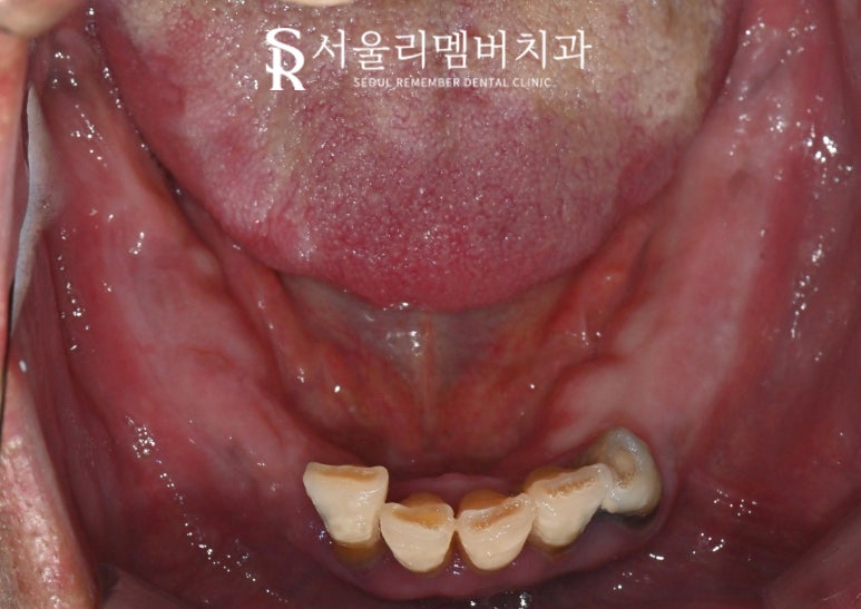 서울대입구역 치과 에서 안전하고 신속 정확하게 발치 후 전악 임플란트 식립한 케이스 관련 이미지 3