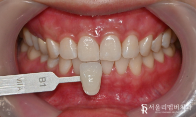 "앞니가 변색돼서 보기 싫어요" 보라매 치과 에서 미백치료 관련 이미지 3