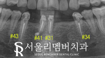 서울대입구역치과 에서 아래 앞니 5개를 임플란트 2개만으로 자연스럽게 회복 관련 이미지 2