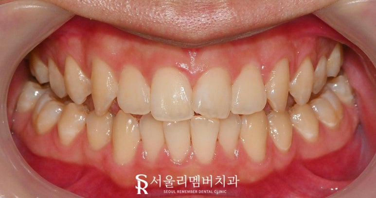 서울대입구 치과 연 1회 보험 스케일링으로 착색 제거 및 잇몸 건강 지키기 관련 이미지 2