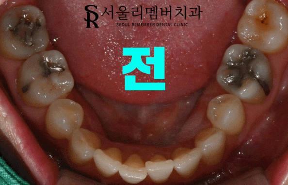 숭실대입구역 치과 에서 이차우식이 생긴 오래된 인레이를 새하얗게 개선해 드렸습니다. 관련 이미지 4