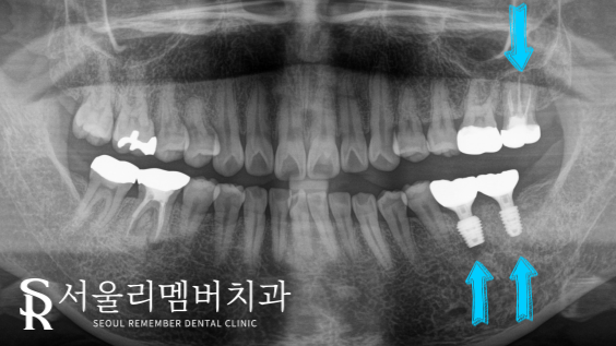 어금니 상실로 인한 치아 정출 낙성대역 치과 임플란트 및 신경치료 증례 관련 이미지 2