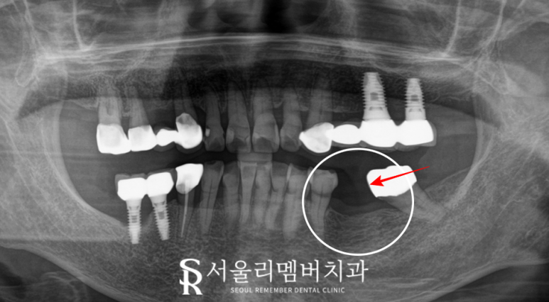 신림역 치과 오스템 BA 임플란트 당일 수술로 빠져버린 어금니 회복 관련 이미지 2