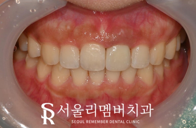 신림 치과 인비절라인 투명교정 후 크라운까지 관련 이미지 3
