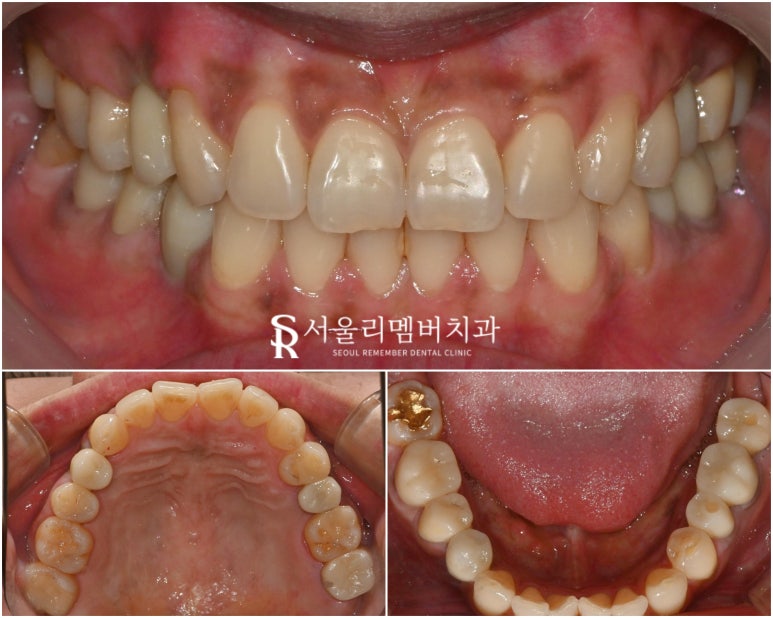 신림 치과 신경치료와 임플란트 어떤 기준으로 결정하게 되는지 궁금하다면 <클릭> 관련 이미지 4